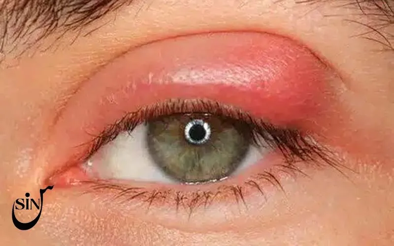 حساسیت به چسب اکستنشن مژه + راهکارهای پیشگیری علمی